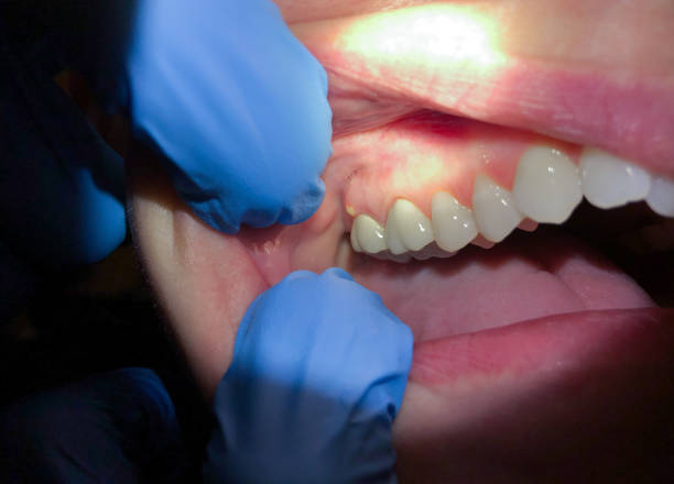 Best Tooth Infection Emergency Dentist  in Douglas, WY